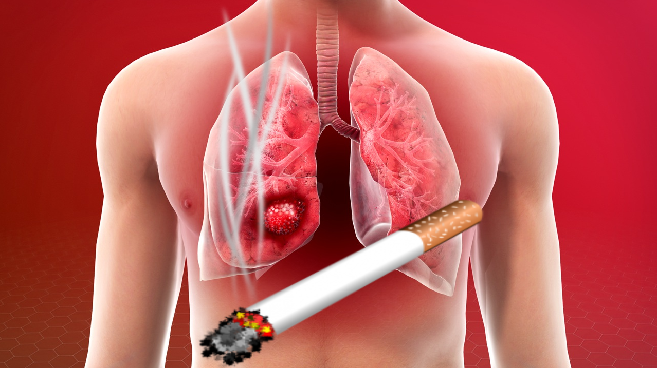 Hút thuốc lá có thể gây ung thư phổi